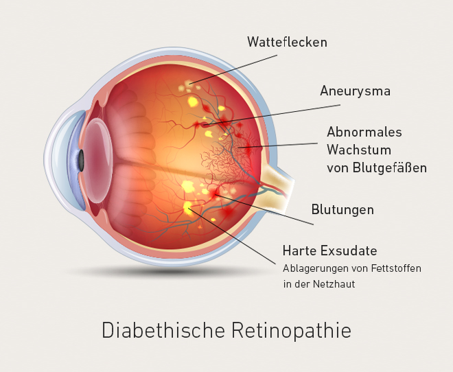 Diabetische Netzhauterkrankungen - Augenpraxisklinik Heidelberg